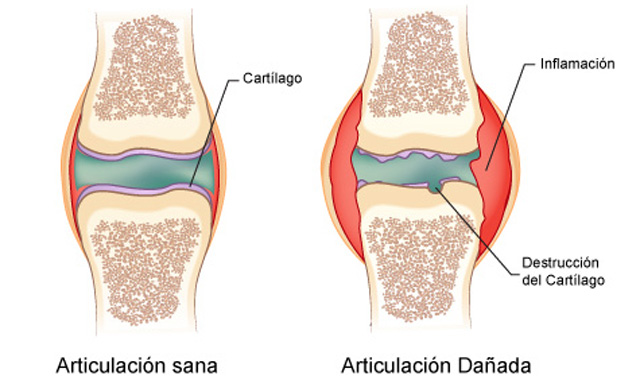 Beneficios del omega 3 para la artritis