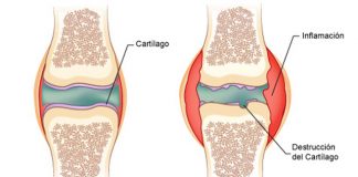 artritis