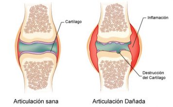 artritis