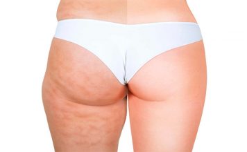 celulitis combatirla con superalimentos